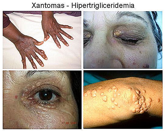 Sintomas de colesterol